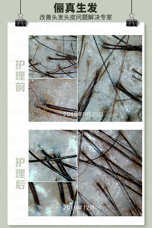 頭油、頭癢