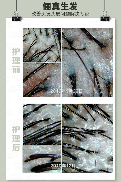 頭油、頭癢